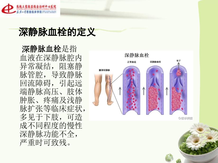 运用PDCA管理降低深静脉血栓的发生率_第2页