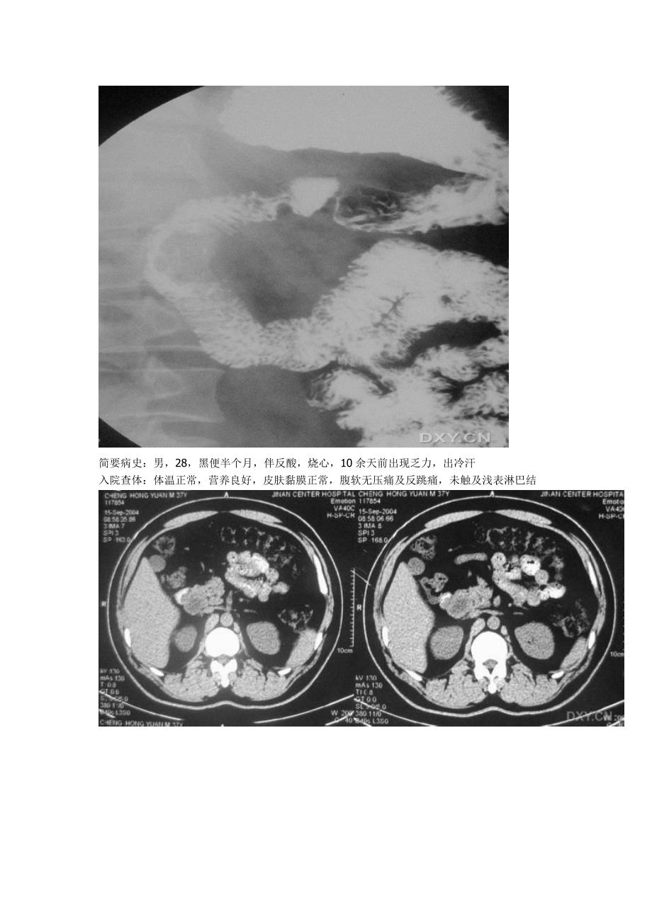 胃肠道间质瘤.doc_第1页