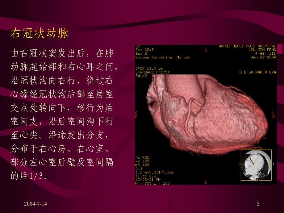 冠状动脉的解剖及CT表现_第3页