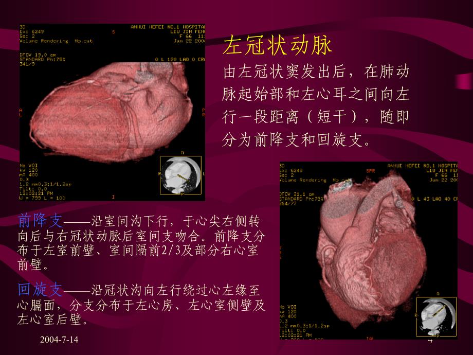 冠状动脉的解剖及CT表现_第4页