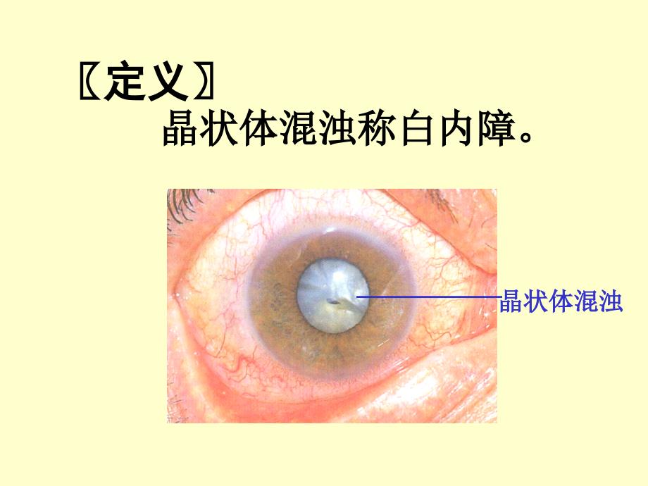 白内障PPT课件_第2页