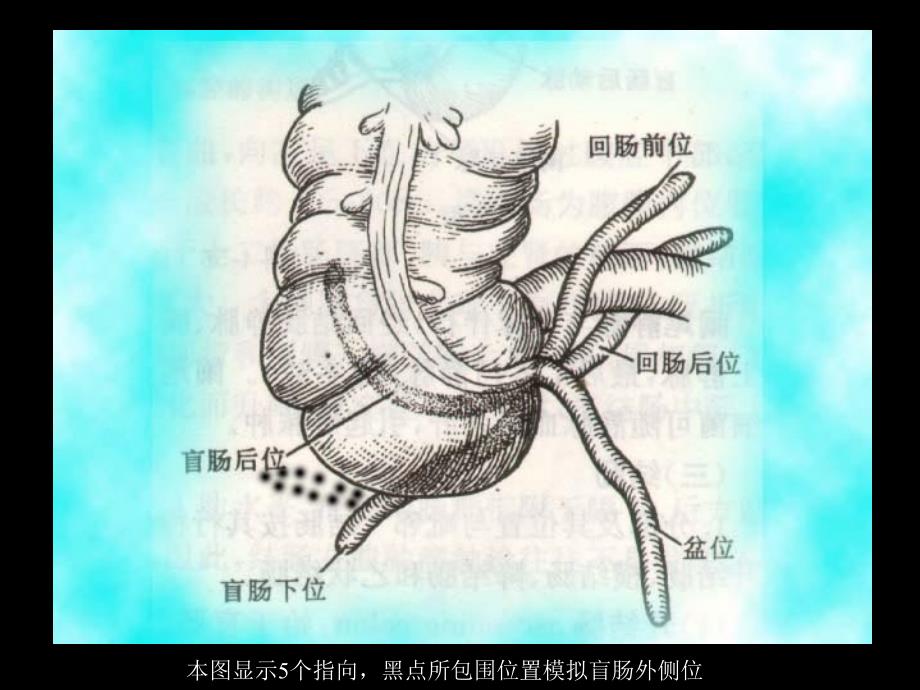 教学阑尾炎.课件_第4页