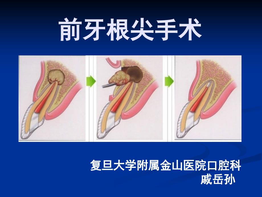 前牙根尖手术课件_第1页