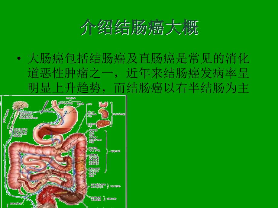 《结肠癌教学查房》PPT课件.ppt_第3页