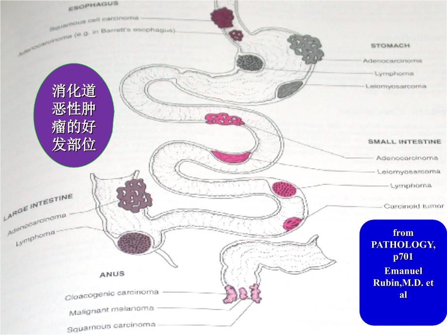 病理学教学课件：肿瘤各论2消化_第3页