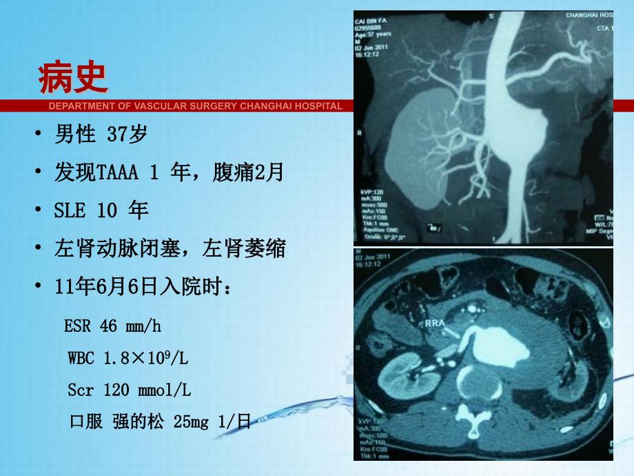 “杂交”手术治疗活动期炎性Ⅳ型胸腹主动脉瘤课件_第2页