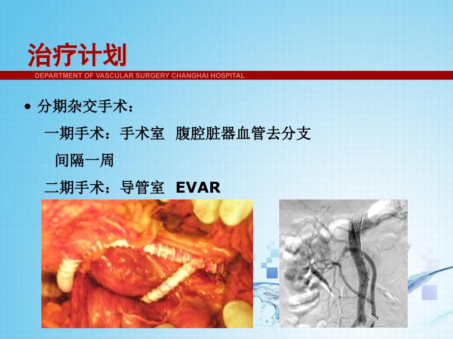 “杂交”手术治疗活动期炎性Ⅳ型胸腹主动脉瘤课件_第3页