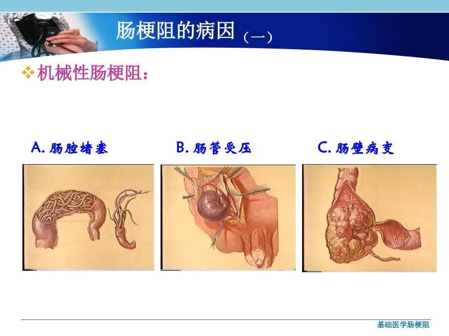 基础医学肠梗阻课件_第5页