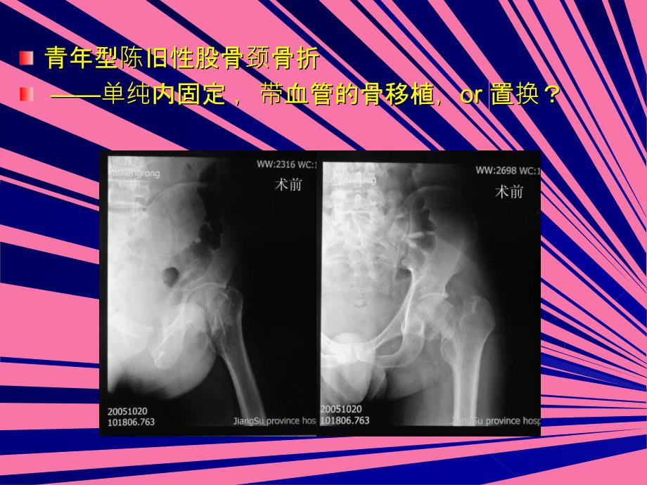 吻合血管游离腓骨移植术治疗股骨颈陈旧骨折及骨不连ppt课件_第2页