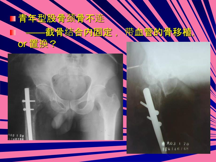 吻合血管游离腓骨移植术治疗股骨颈陈旧骨折及骨不连ppt课件_第3页