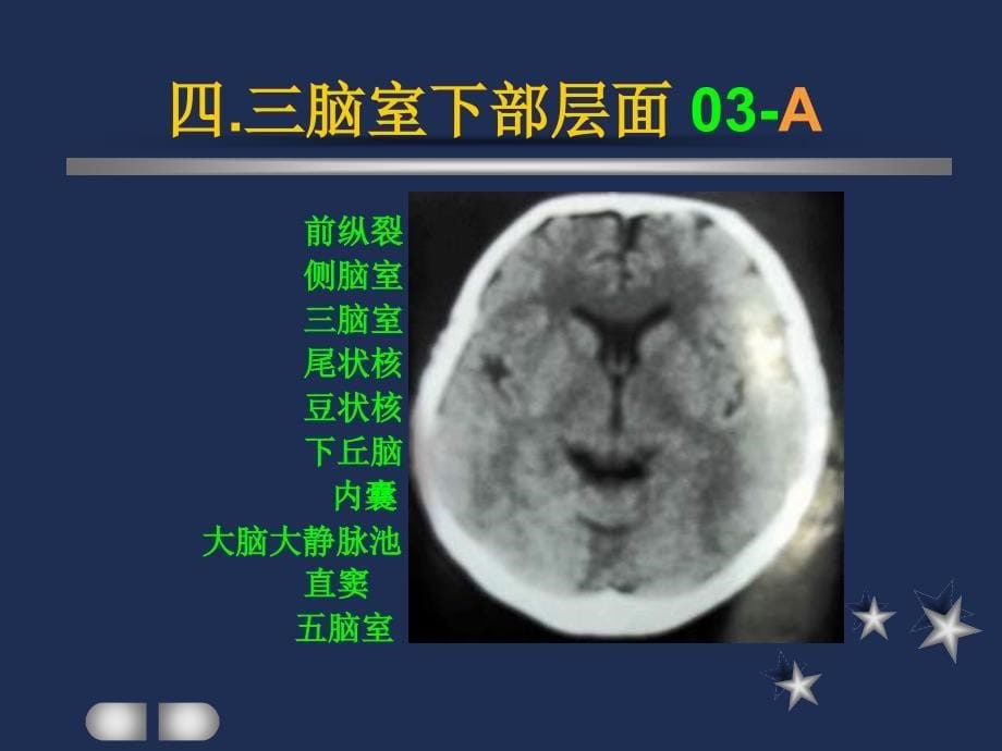 四.三脑室下部层面解剖要点_第5页