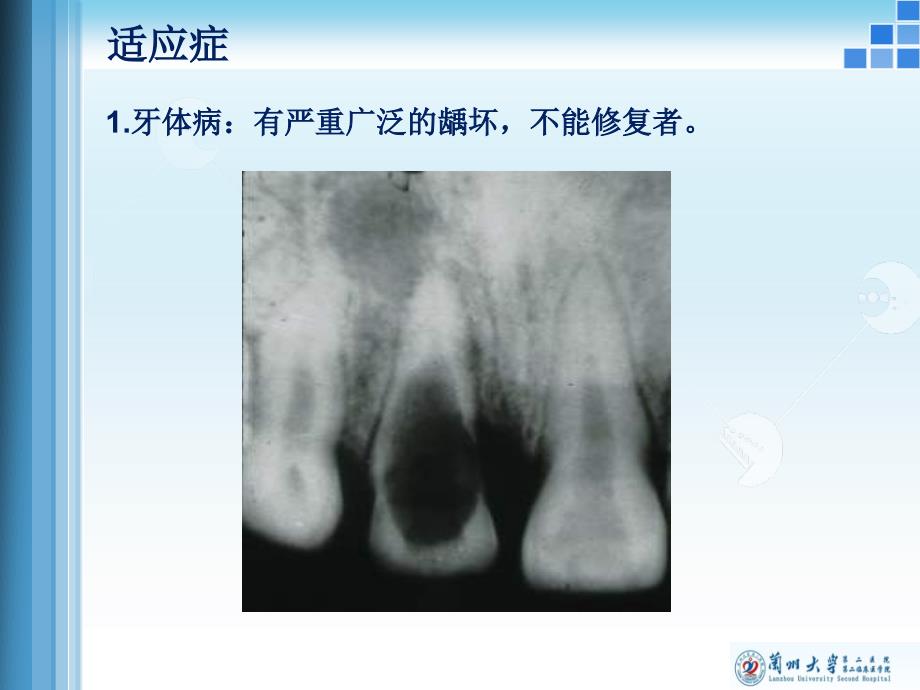 牙及牙槽外科课件_第4页