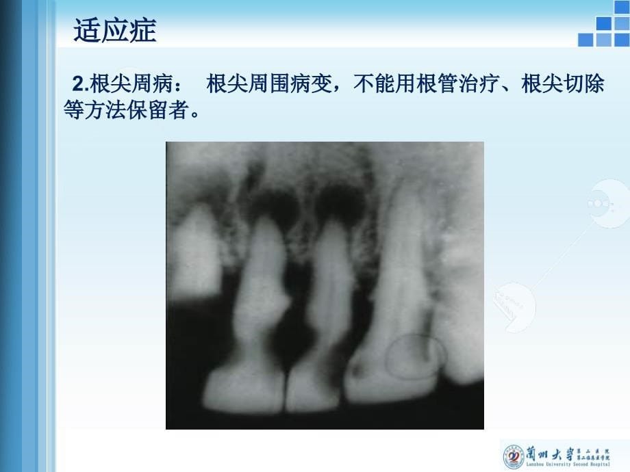 牙及牙槽外科课件_第5页