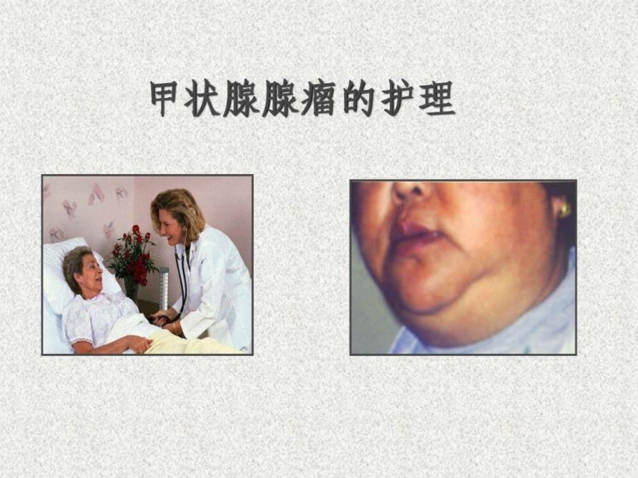 甲状腺舌下腺疾病的护理图文.ppt_第1页