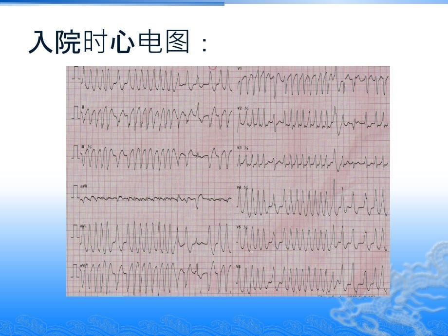 预激合并心房颤动PPT培训课件_第5页