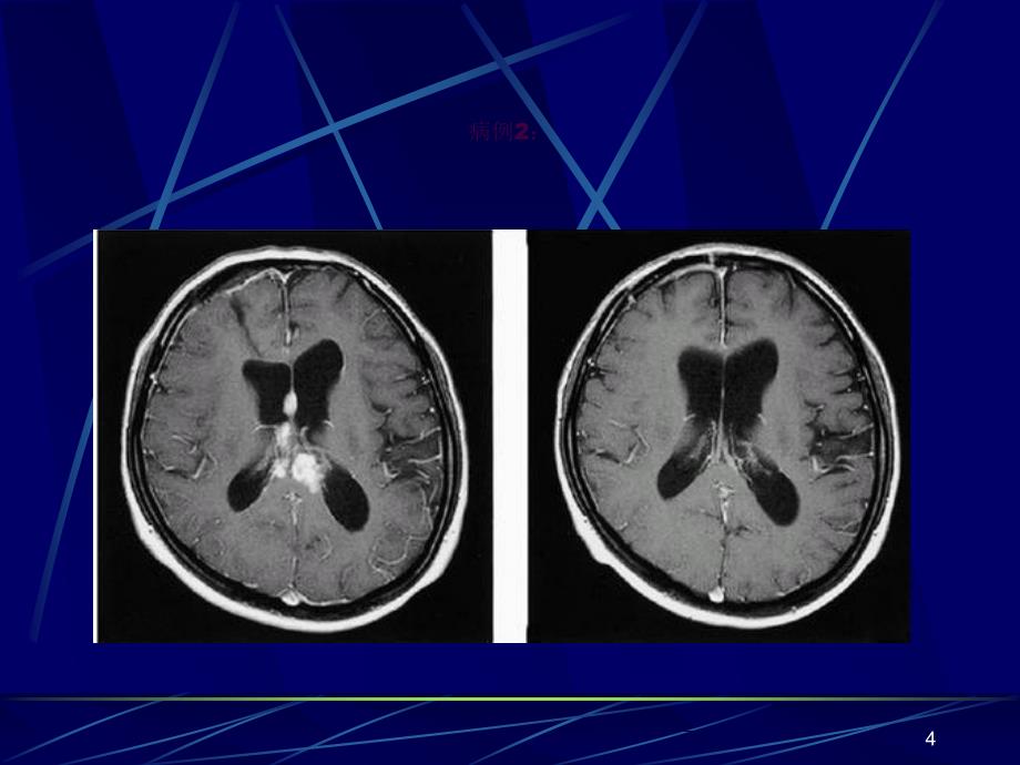中枢神经系统淋巴瘤的影像学诊断ppt课件_第4页