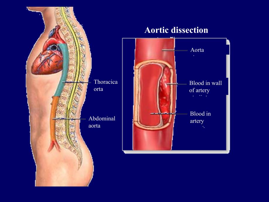 医学专题：主动脉夹层-精美PPT_第4页