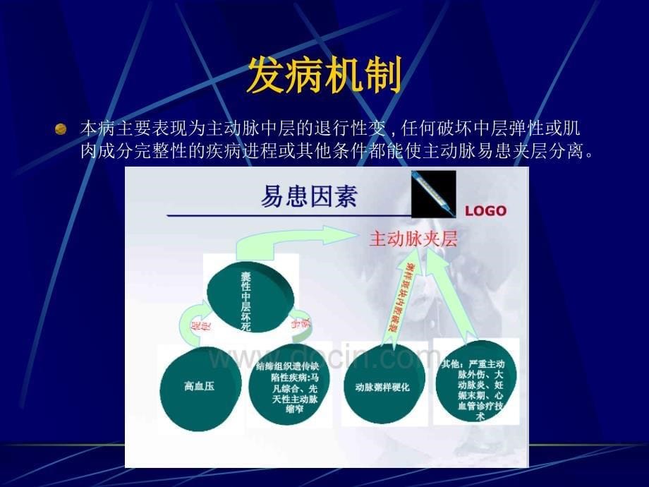 医学专题：主动脉夹层-精美PPT_第5页