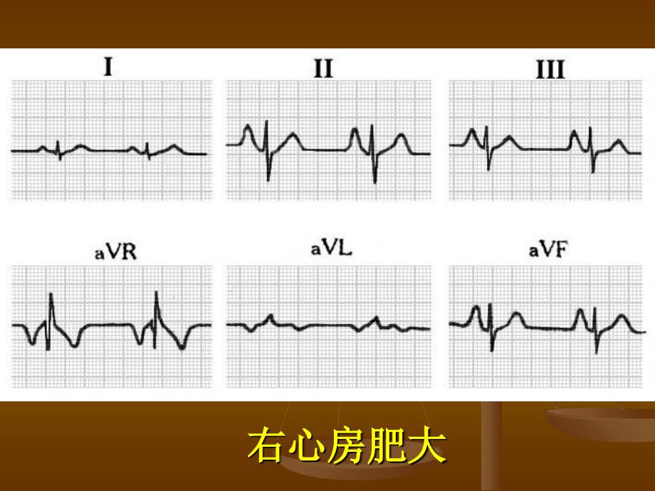 最新心电图学习二PPT文档_第3页