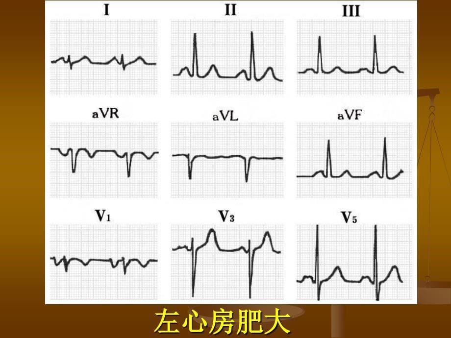 最新心电图学习二PPT文档_第5页