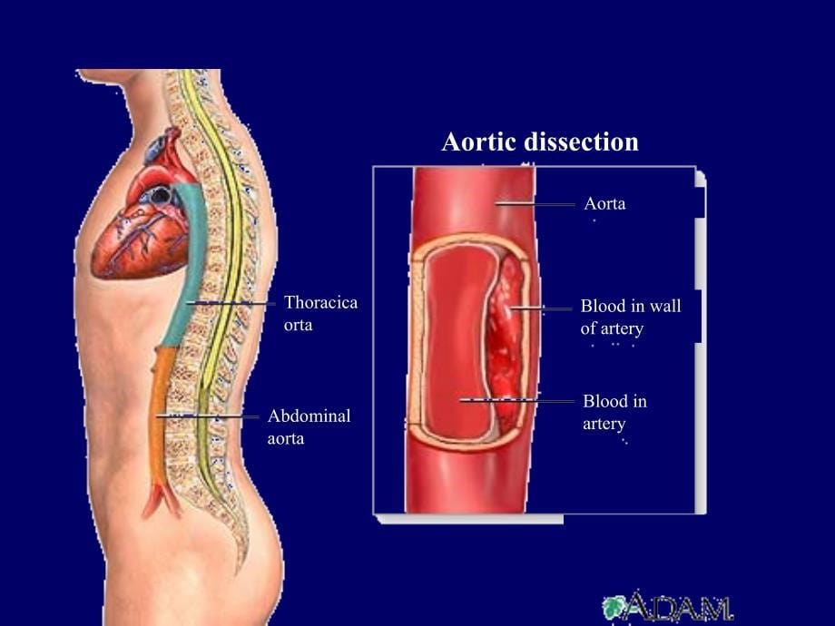 主动脉夹层PPT课件_第5页