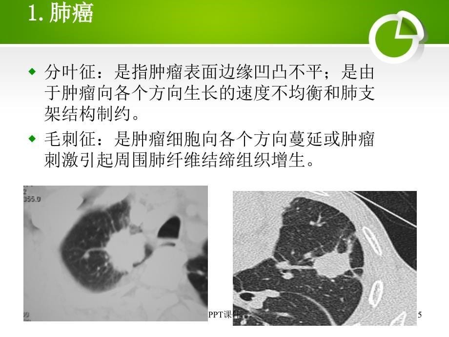 孤立性肺结节的影像学诊断和鉴别诊断ppt课件_第5页