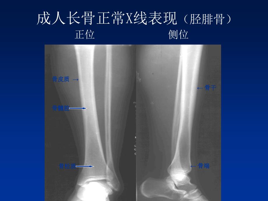 骨与关节基本病变X线_第4页