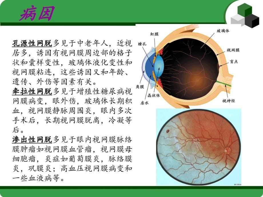 视网膜脱落小讲课ppt课件_第5页