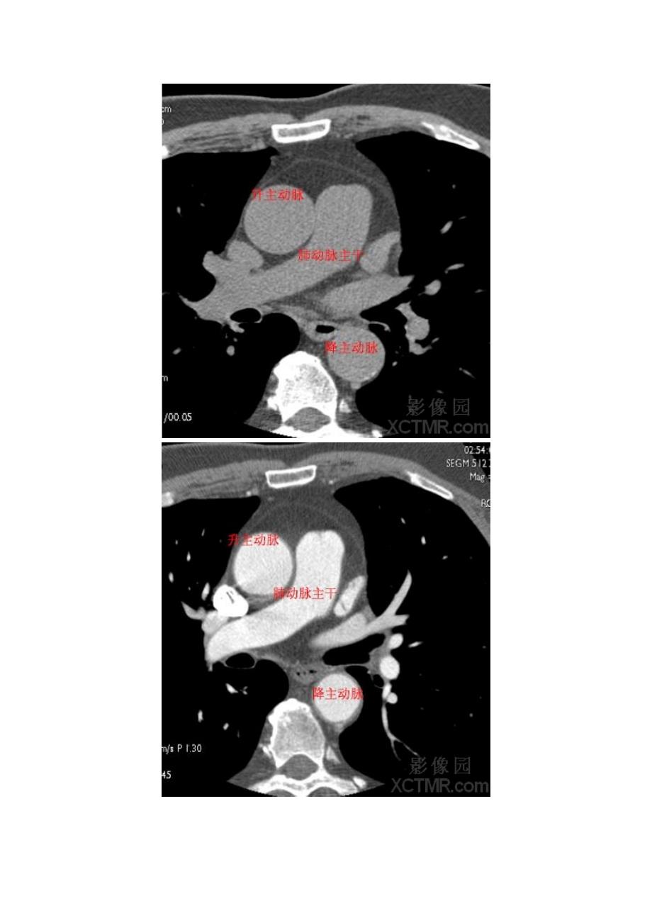 心脏CT解剖图谱_第3页