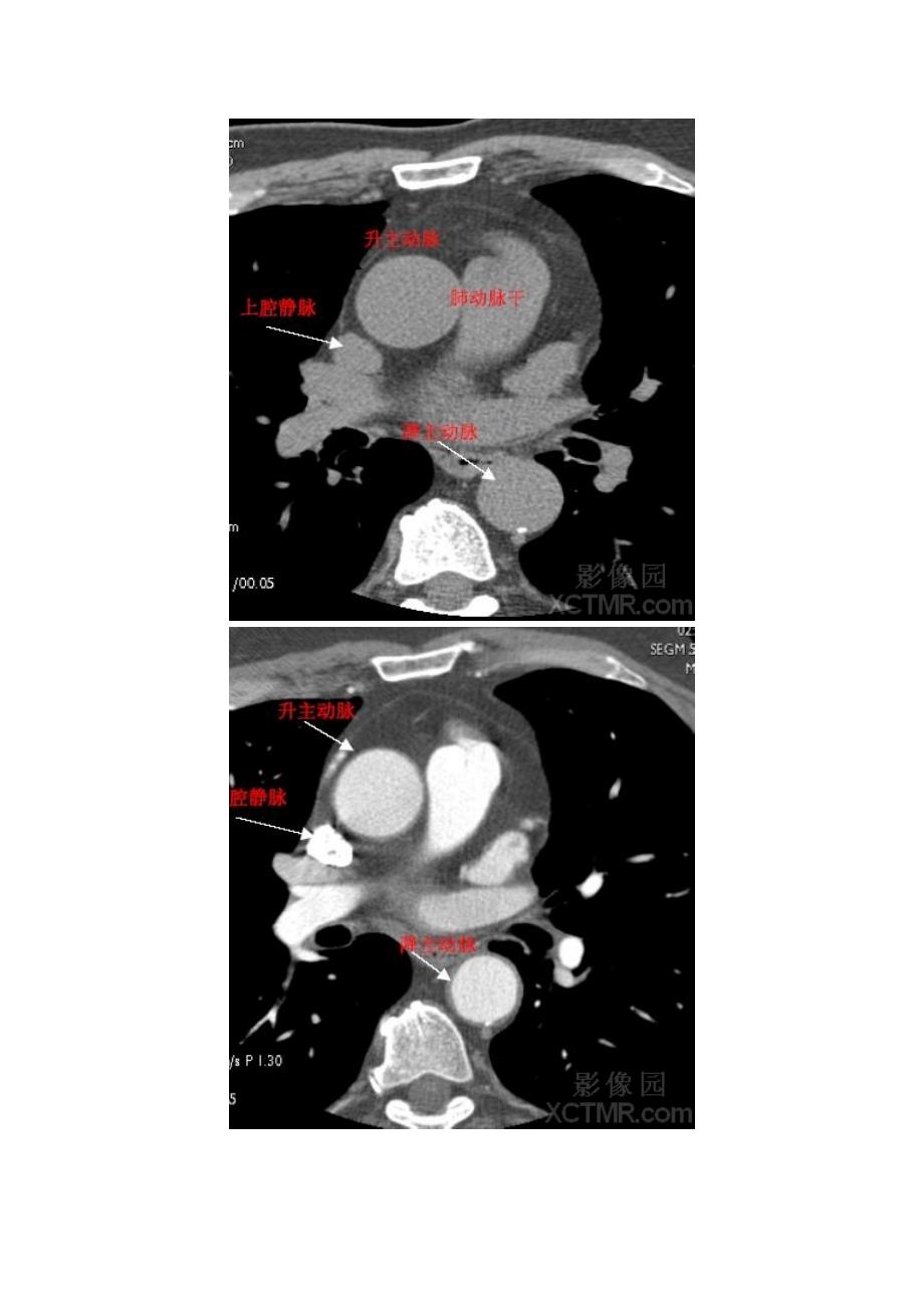 心脏CT解剖图谱_第4页