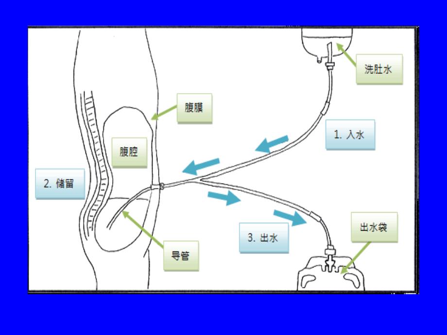 腹膜透析护理课件.ppt_第3页