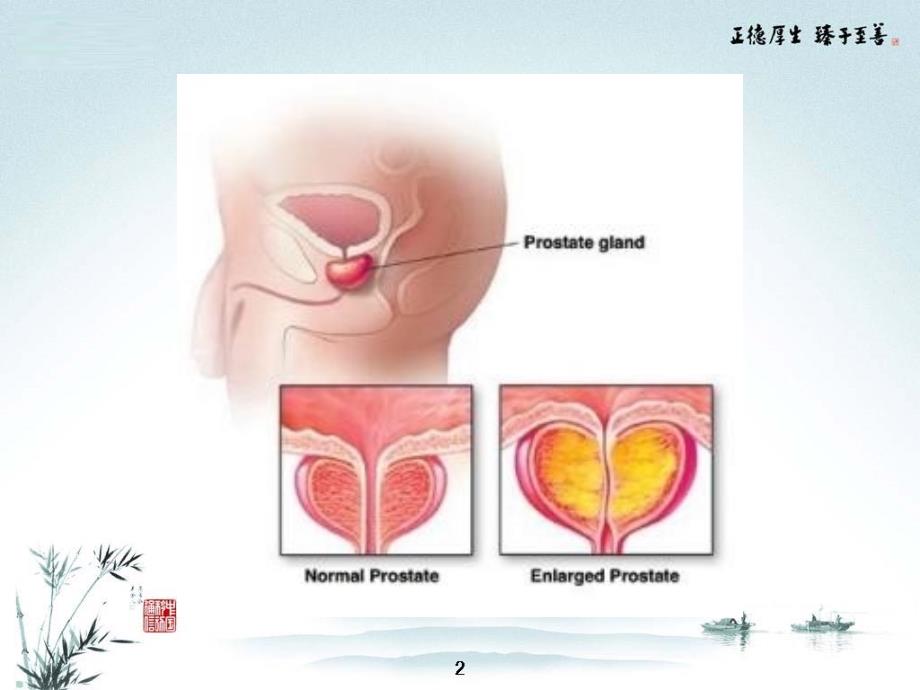 前列腺增生护理PPTPPT文档_第2页