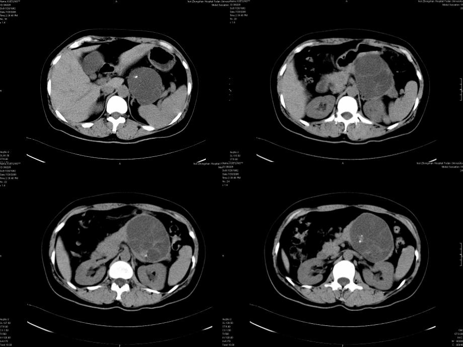 粘液性囊腺瘤讲座课件_第2页