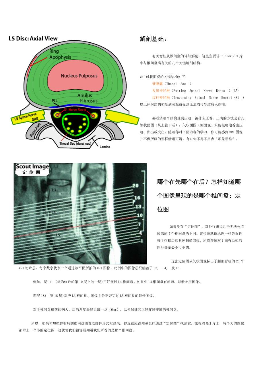 椎间盘突出CT,MRI解读.doc_第1页