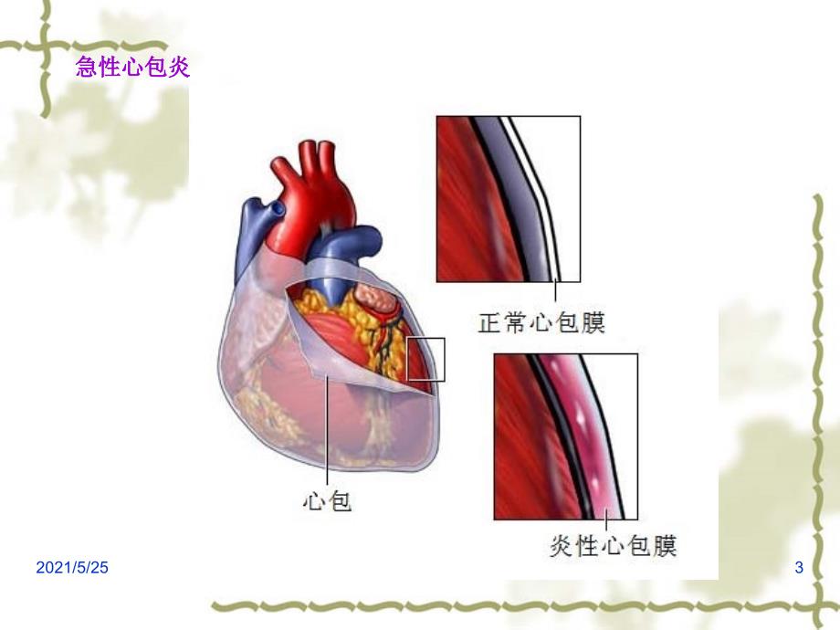 急性心包炎心电图表现PPT优秀课件_第3页