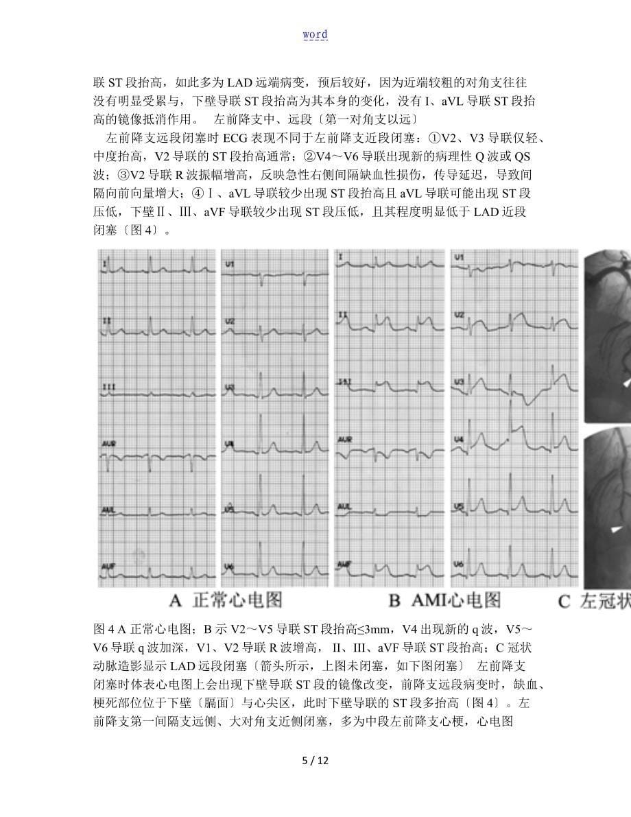 心电图对ST段抬高型心肌梗死罪犯血管地定位诊断_第5页