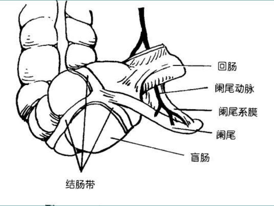 急性阑尾炎一点通ppt课件_第3页