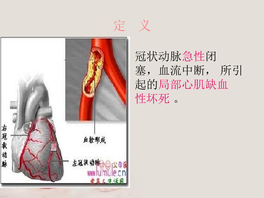 急性心肌梗死的护理查房郭敏_第3页