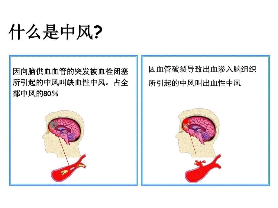 如何预防脑卒中_第5页