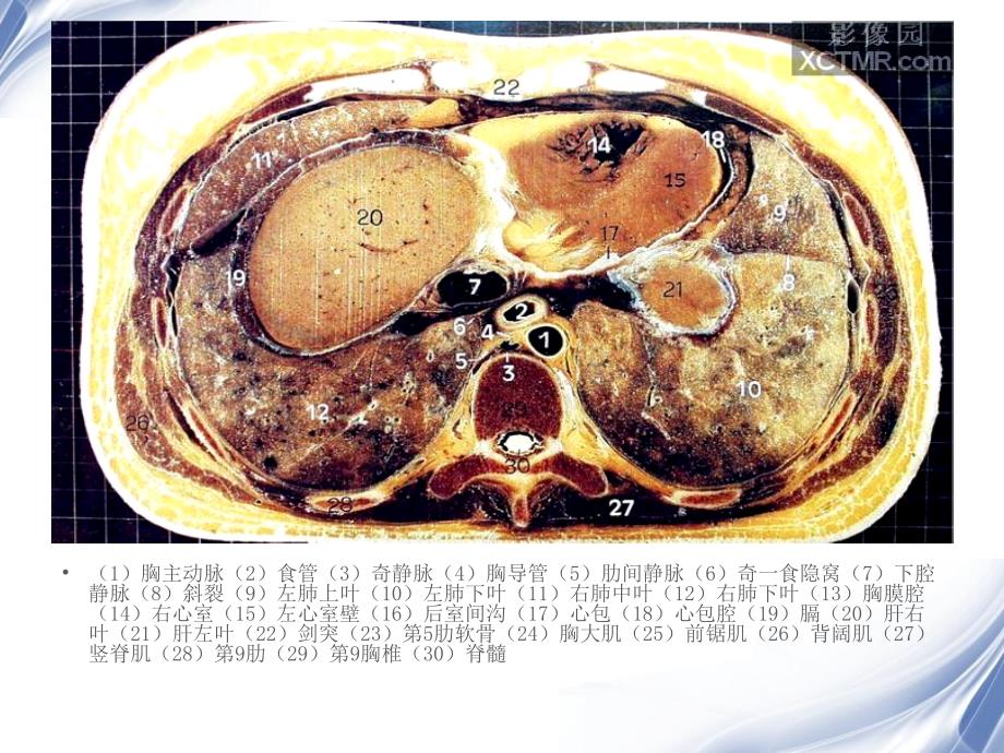 人体断层解剖图谱腹腔_第3页