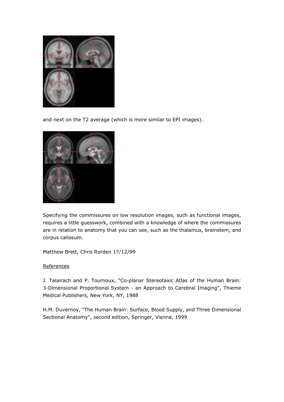 大脑前联合及后联合_第3页