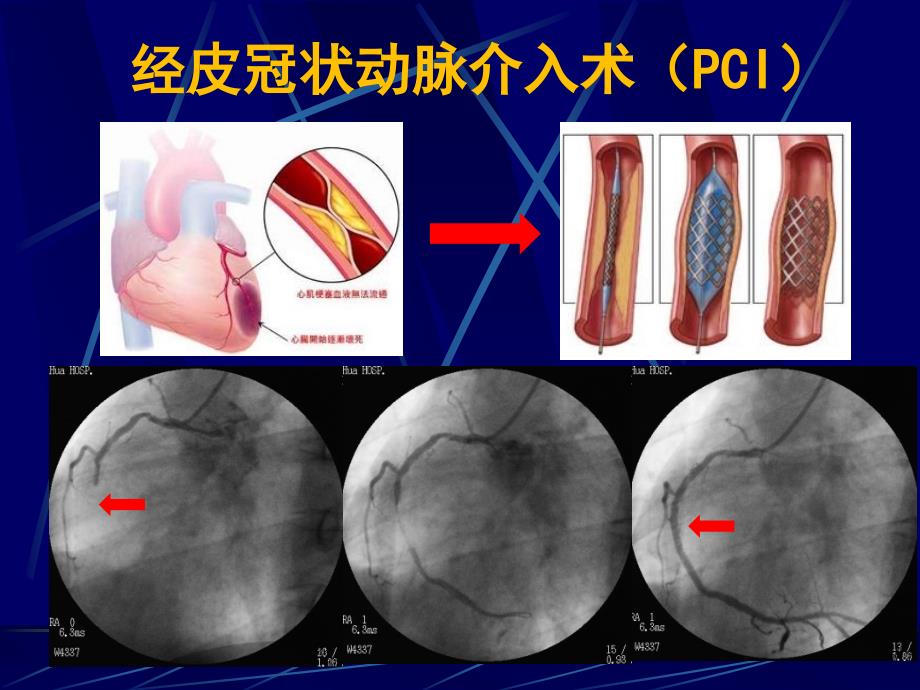 奇妙的介入治疗最终版pp课件_第4页