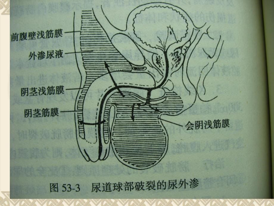 尿道损伤讲课ppt课件_第5页