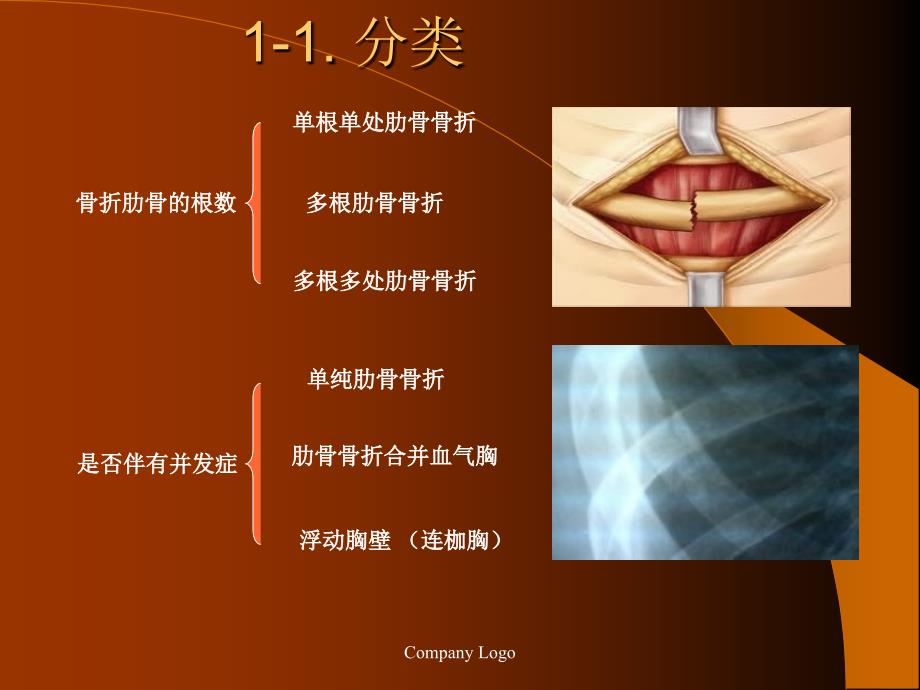 肋骨骨折的外科治疗_第4页