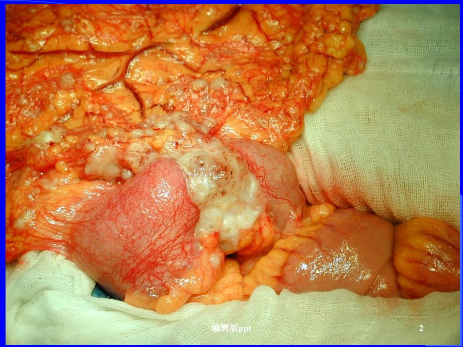 大肠癌讲义课件_第2页