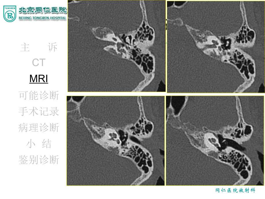 淋巴囊肿瘤ppt课件_第4页