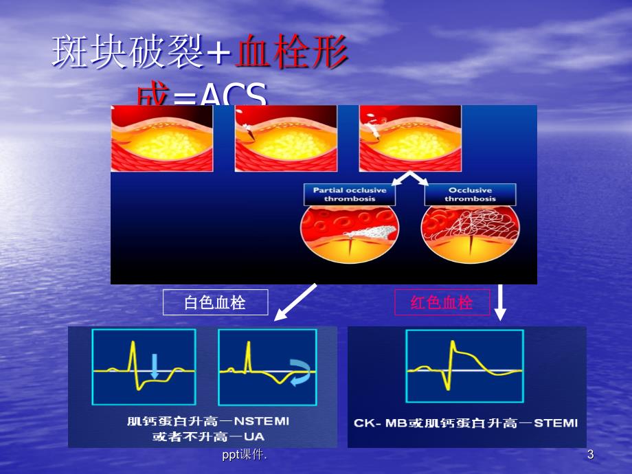 ACS的院前急救ppt课件_第3页