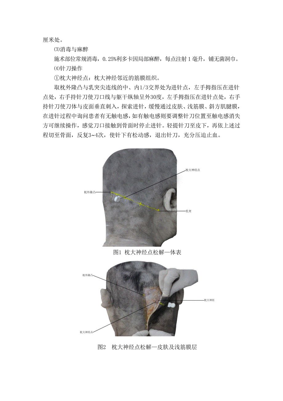 头痛（颈源性头痛）中医诊疗方案2018版_第3页