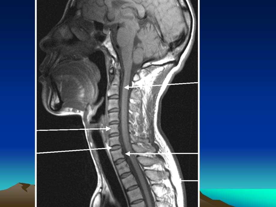 脊髓和椎管内疾病PPT课件_第3页