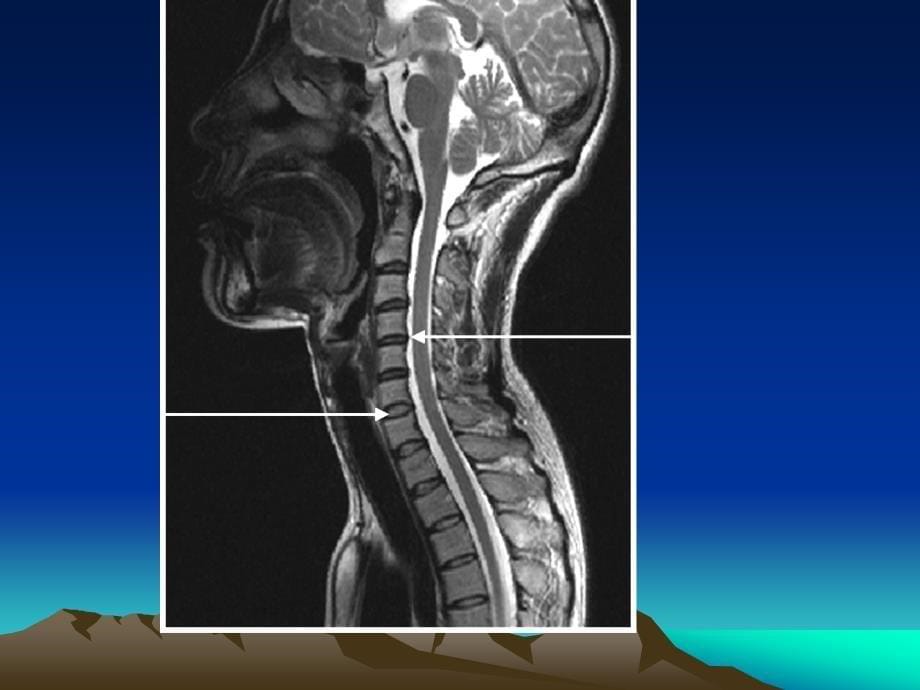 脊髓和椎管内疾病PPT课件_第5页